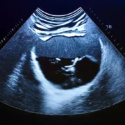 4,5 miliona Polaków żyje z cichą chorobą